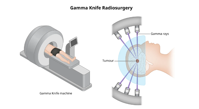 Gamma-kés